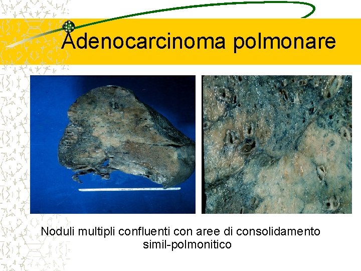 Adenocarcinoma polmonare Noduli multipli confluenti con aree di consolidamento simil-polmonitico 