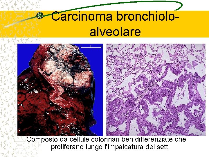 Carcinoma bronchioloalveolare Composto da cellule colonnari ben differenziate che proliferano lungo l’impalcatura dei setti