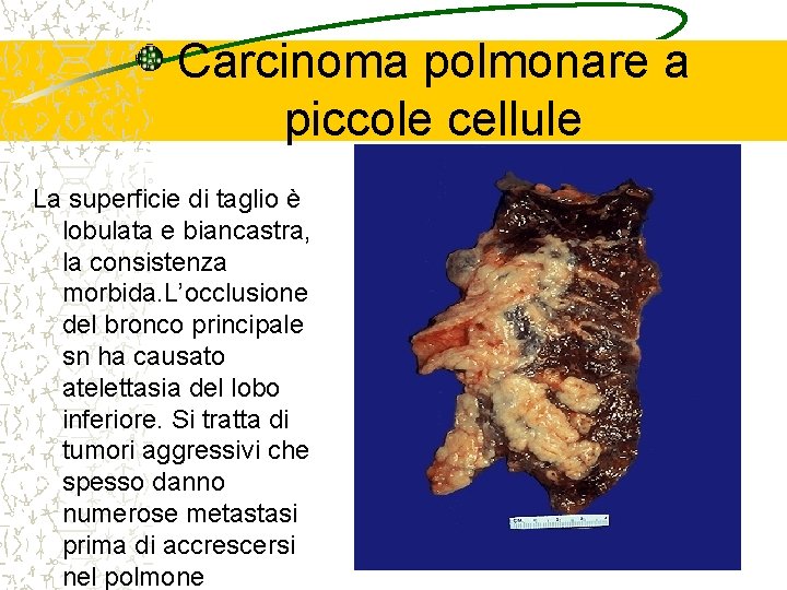 Carcinoma polmonare a piccole cellule La superficie di taglio è lobulata e biancastra, la