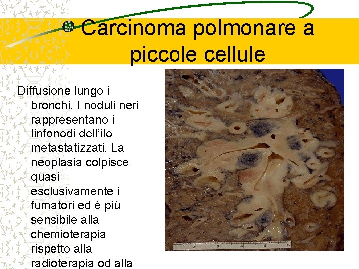 Carcinoma polmonare a piccole cellule Diffusione lungo i bronchi. I noduli neri rappresentano i