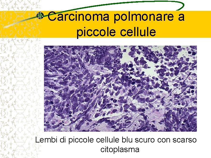 Carcinoma polmonare a piccole cellule Lembi di piccole cellule blu scuro con scarso citoplasma