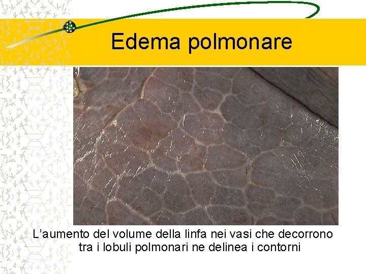 Edema polmonare L’aumento del volume della linfa nei vasi che decorrono tra i lobuli