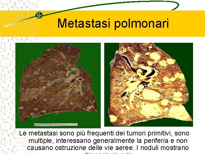 Metastasi polmonari Le metastasi sono più frequenti dei tumori primitivi, sono multiple, interessano generalmente