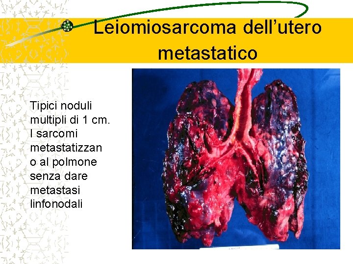 Leiomiosarcoma dell’utero metastatico Tipici noduli multipli di 1 cm. I sarcomi metastatizzan o al