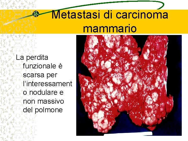 Metastasi di carcinoma mammario La perdita funzionale è scarsa per l’interessament o nodulare e