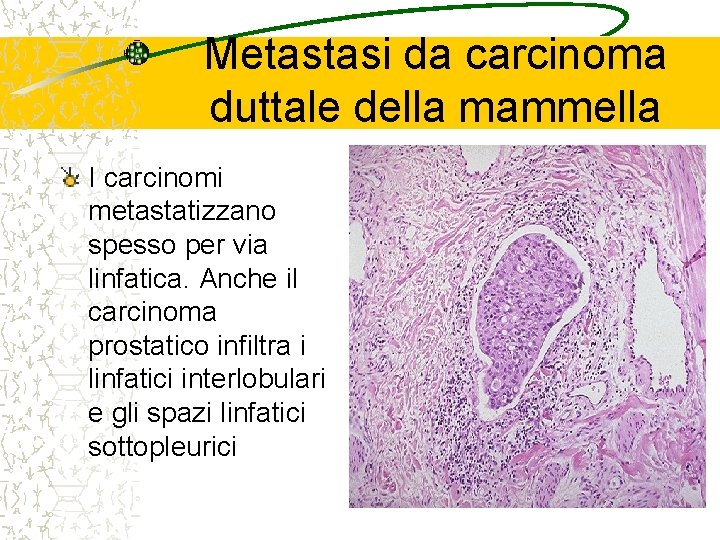 Metastasi da carcinoma duttale della mammella I carcinomi metastatizzano spesso per via linfatica. Anche