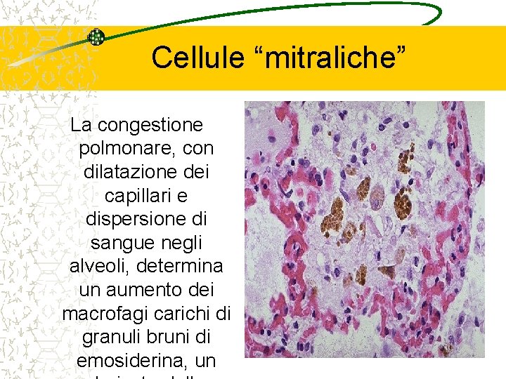 Cellule “mitraliche” La congestione polmonare, con dilatazione dei capillari e dispersione di sangue negli