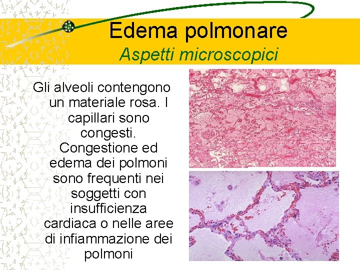 Edema polmonare Aspetti microscopici Gli alveoli contengono un materiale rosa. I capillari sono congesti.