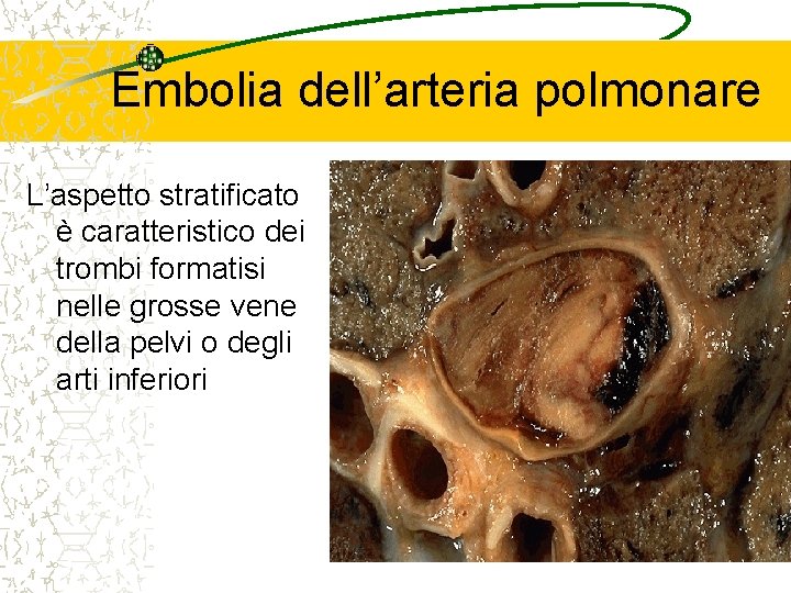 Embolia dell’arteria polmonare L’aspetto stratificato è caratteristico dei trombi formatisi nelle grosse vene della