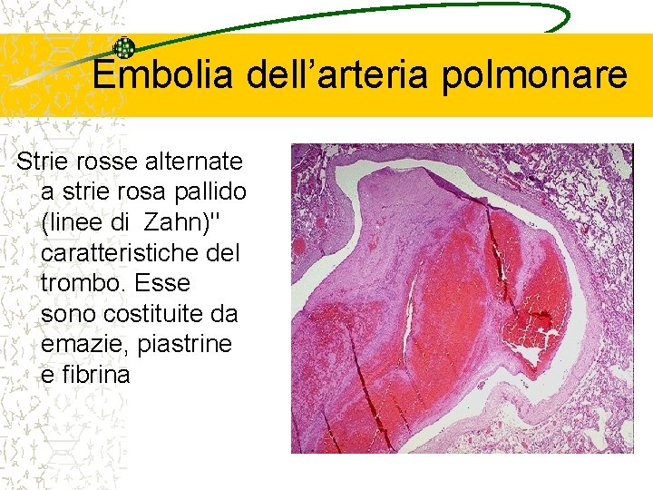 Embolia dell’arteria polmonare Strie rosse alternate a strie rosa pallido (linee di Zahn)" caratteristiche