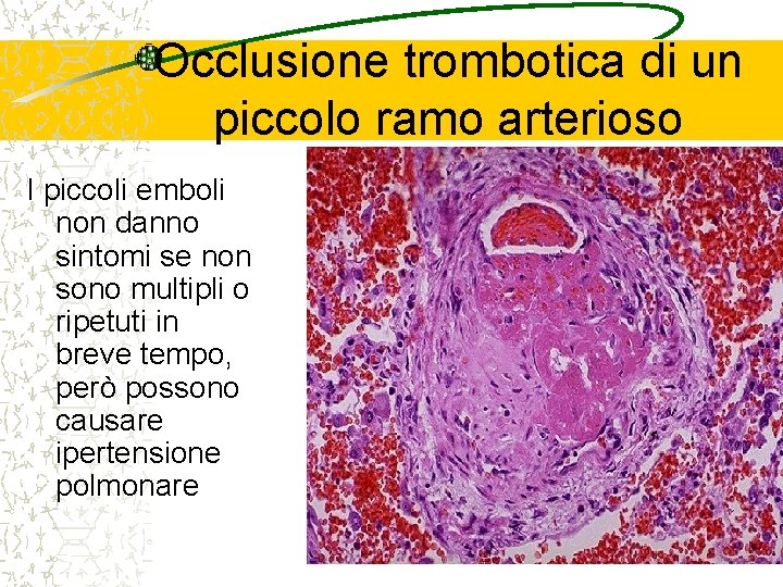 Occlusione trombotica di un piccolo ramo arterioso I piccoli emboli non danno sintomi se