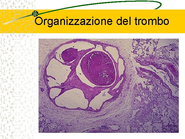 Organizzazione del trombo 