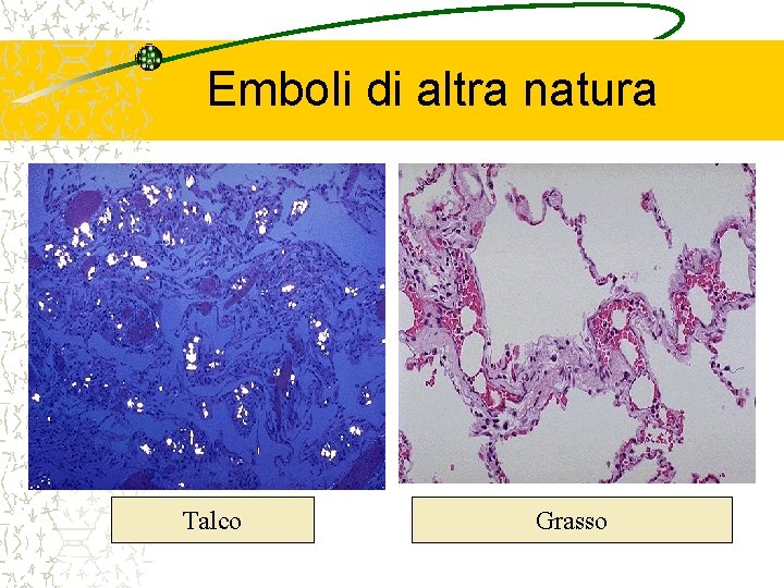 Emboli di altra natura Talco Grasso 