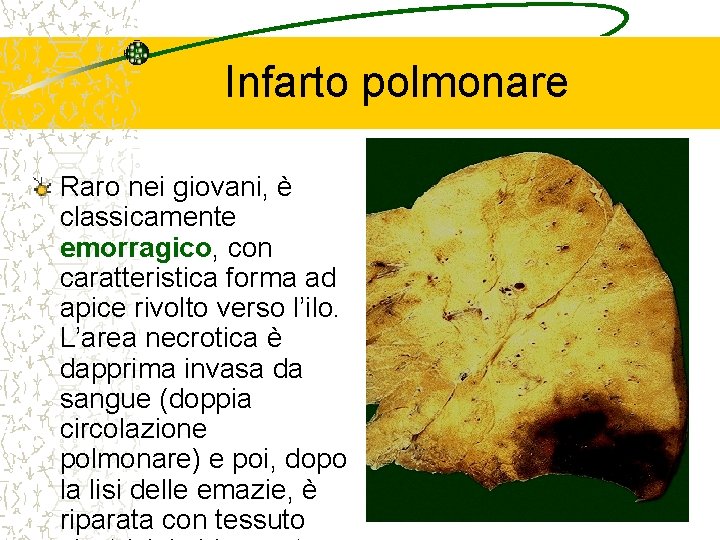 Infarto polmonare Raro nei giovani, è classicamente emorragico, con caratteristica forma ad apice rivolto