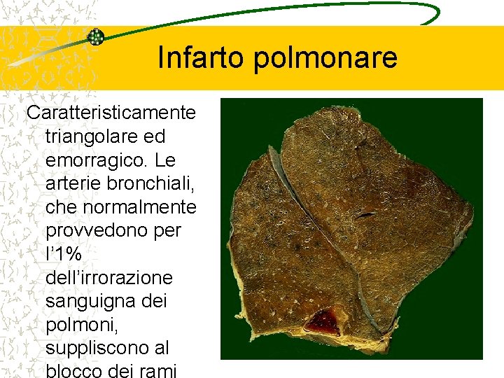 Infarto polmonare Caratteristicamente triangolare ed emorragico. Le arterie bronchiali, che normalmente provvedono per l’