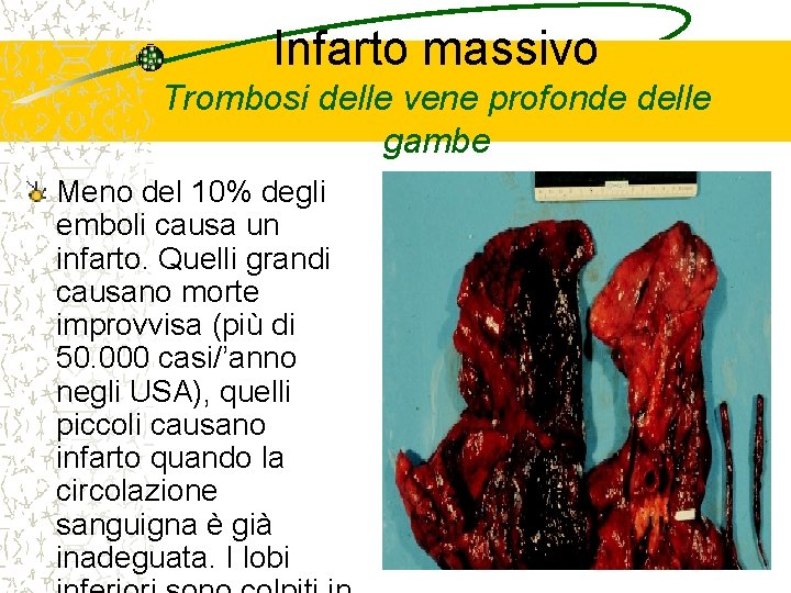 Infarto massivo Trombosi delle vene profonde delle gambe Meno del 10% degli emboli causa