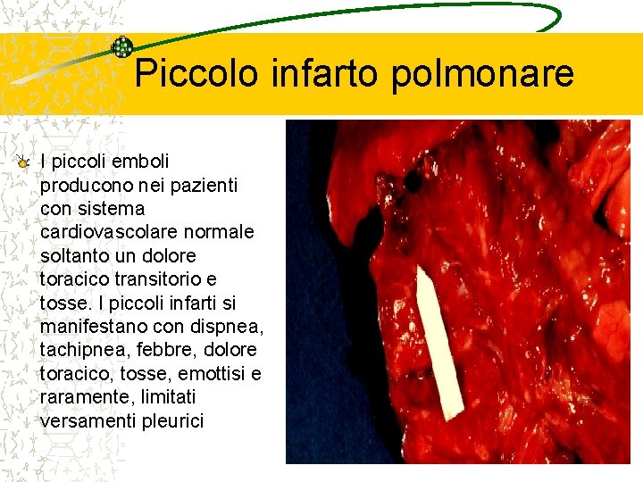 Piccolo infarto polmonare I piccoli emboli producono nei pazienti con sistema cardiovascolare normale soltanto