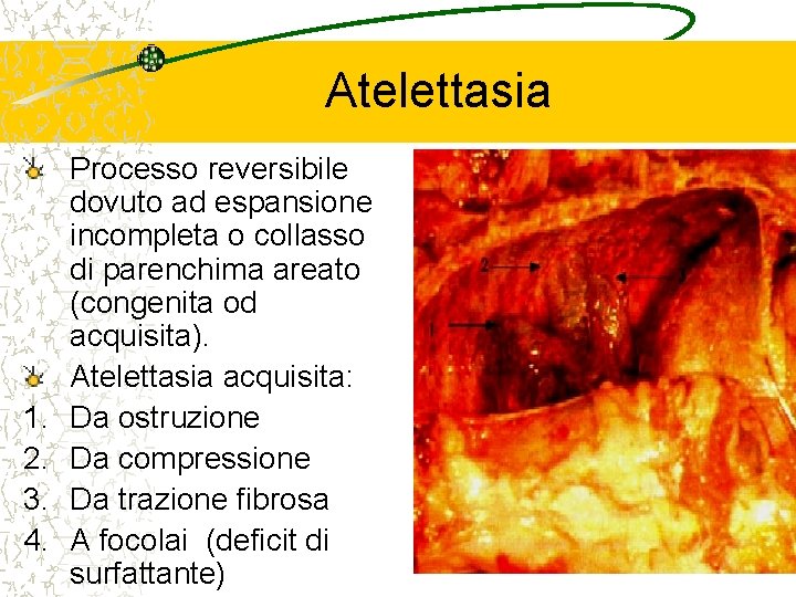 Atelettasia 1. 2. 3. 4. Processo reversibile dovuto ad espansione incompleta o collasso di