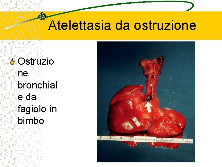 Atelettasia da ostruzione Ostruzio ne bronchial e da fagiolo in bimbo 