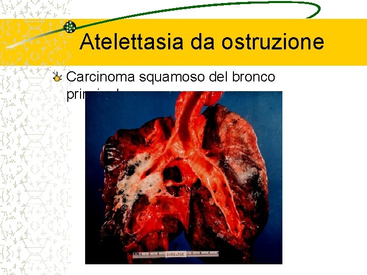 Atelettasia da ostruzione Carcinoma squamoso del bronco principale 