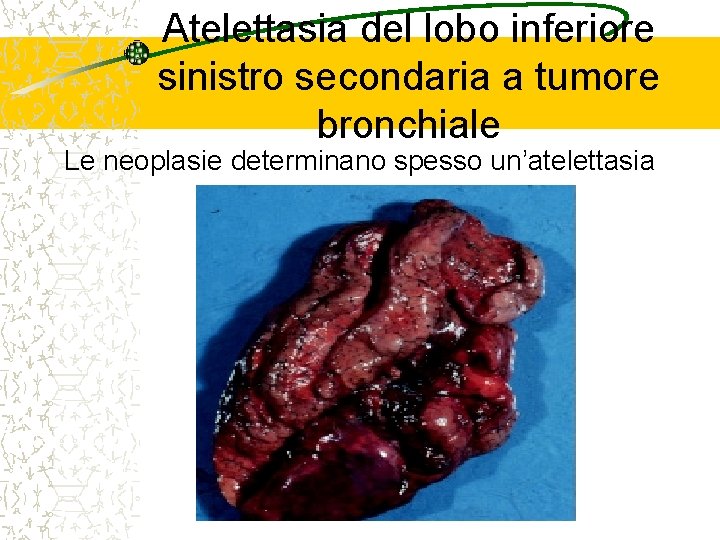 Atelettasia del lobo inferiore sinistro secondaria a tumore bronchiale Le neoplasie determinano spesso un’atelettasia