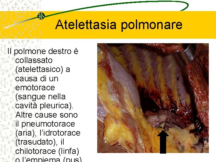 Atelettasia polmonare Il polmone destro è collassato (atelettasico) a causa di un emotorace (sangue