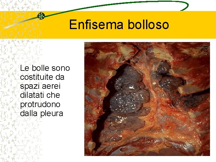 Enfisema bolloso Le bolle sono costituite da spazi aerei dilatati che protrudono dalla pleura