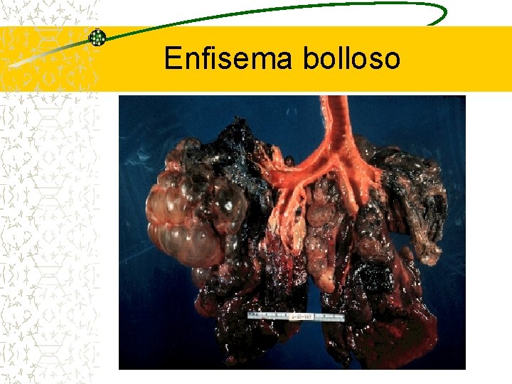 Enfisema bolloso 