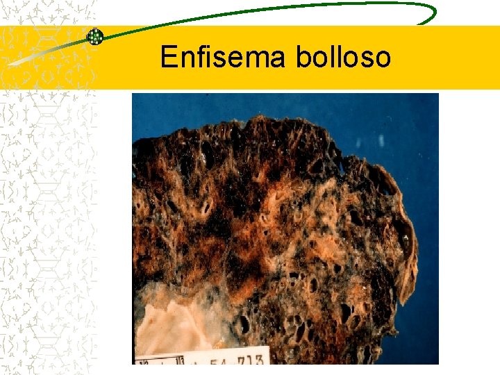 Enfisema bolloso 