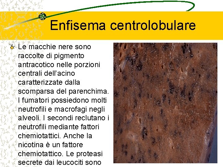 Enfisema centrolobulare Le macchie nere sono raccolte di pigmento antracotico nelle porzioni centrali dell’acino