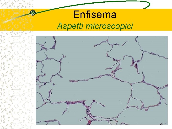 Enfisema Aspetti microscopici 