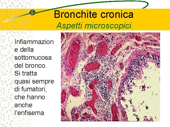 Bronchite cronica Aspetti microscopici Infiammazion e della sottomucosa del bronco. Si tratta quasi sempre