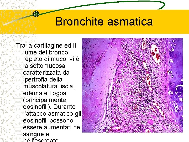 Bronchite asmatica Tra la cartilagine ed il lume del bronco repleto di muco, vi