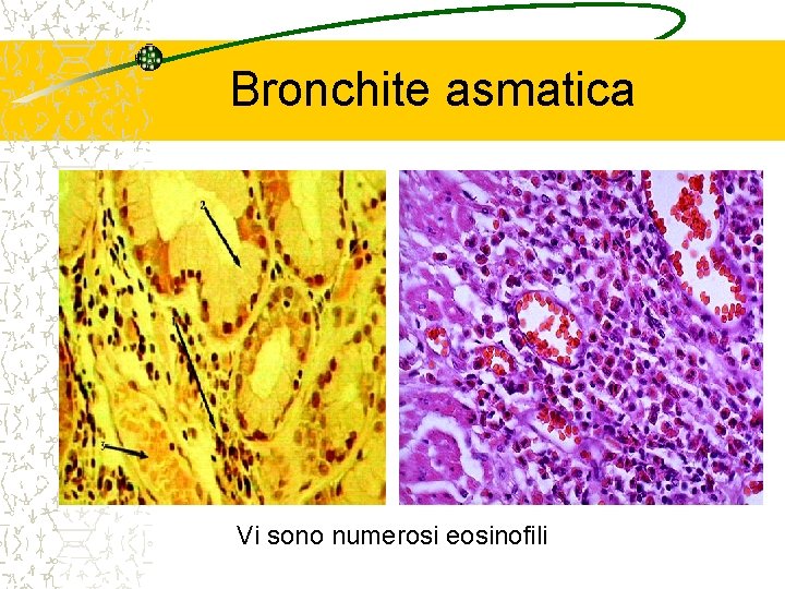 Bronchite asmatica Vi sono numerosi eosinofili 