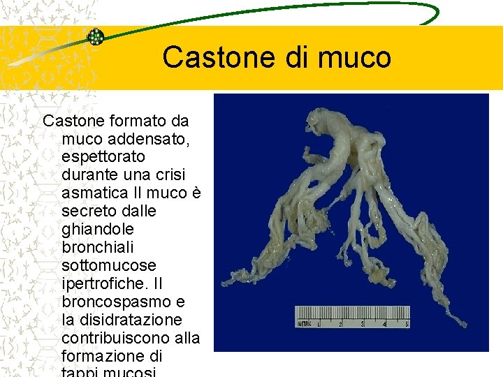 Castone di muco Castone formato da muco addensato, espettorato durante una crisi asmatica Il