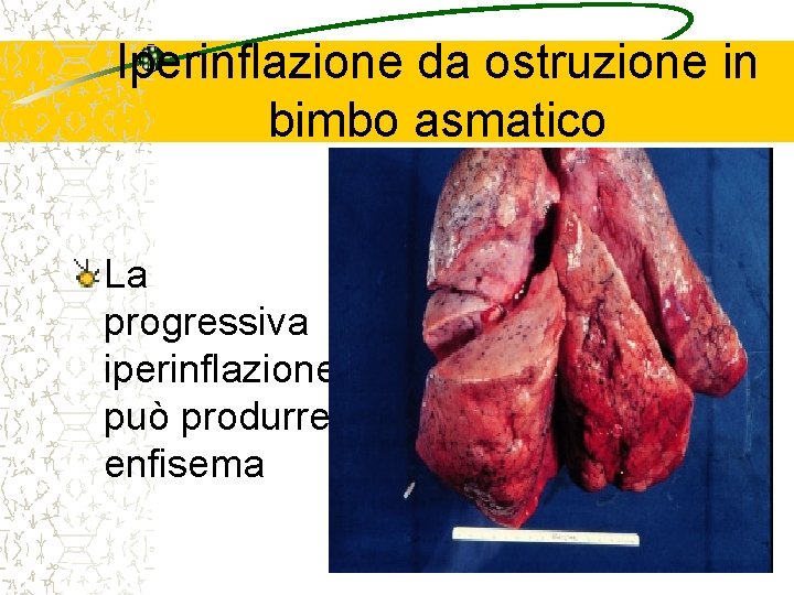 Iperinflazione da ostruzione in bimbo asmatico La progressiva iperinflazione può produrre enfisema 