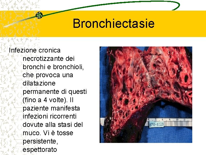 Bronchiectasie Infezione cronica necrotizzante dei bronchi e bronchioli, che provoca una dilatazione permanente di