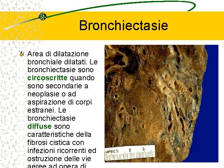 Bronchiectasie Area di dilatazione bronchiale dilatati. Le bronchiectasie sono circoscritte quando sono secondarie a