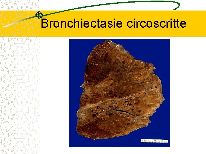 Bronchiectasie circoscritte 