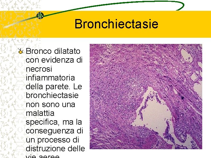 Bronchiectasie Bronco dilatato con evidenza di necrosi infiammatoria della parete. Le bronchiectasie non sono