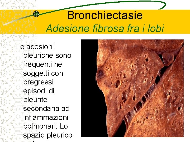 Bronchiectasie Adesione fibrosa fra i lobi Le adesioni pleuriche sono frequenti nei soggetti con