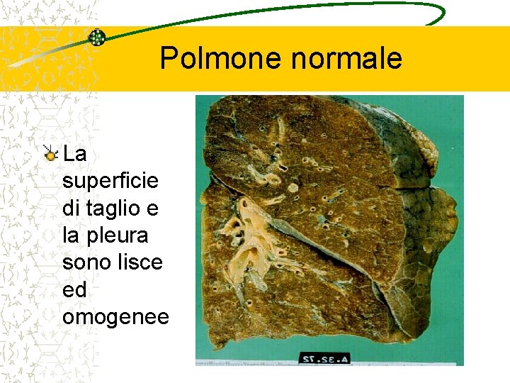 Polmone normale La superficie di taglio e la pleura sono lisce ed omogenee 