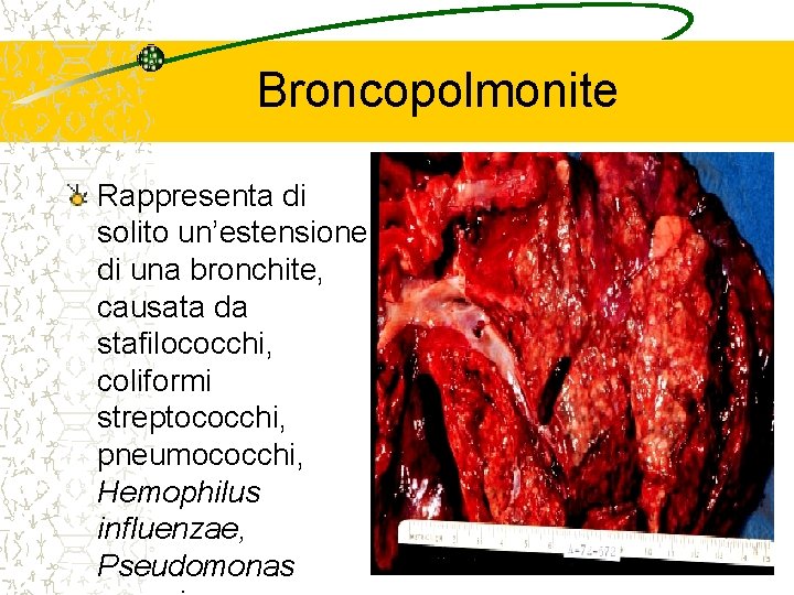 Broncopolmonite Rappresenta di solito un’estensione di una bronchite, causata da stafilococchi, coliformi streptococchi, pneumococchi,