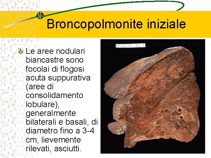 Broncopolmonite iniziale Le aree nodulari biancastre sono focolai di flogosi acuta suppurativa (aree di