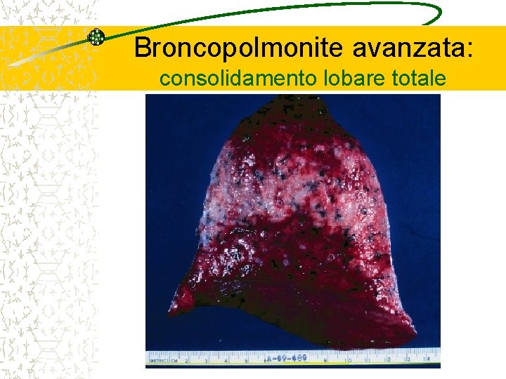 Broncopolmonite avanzata: consolidamento lobare totale 