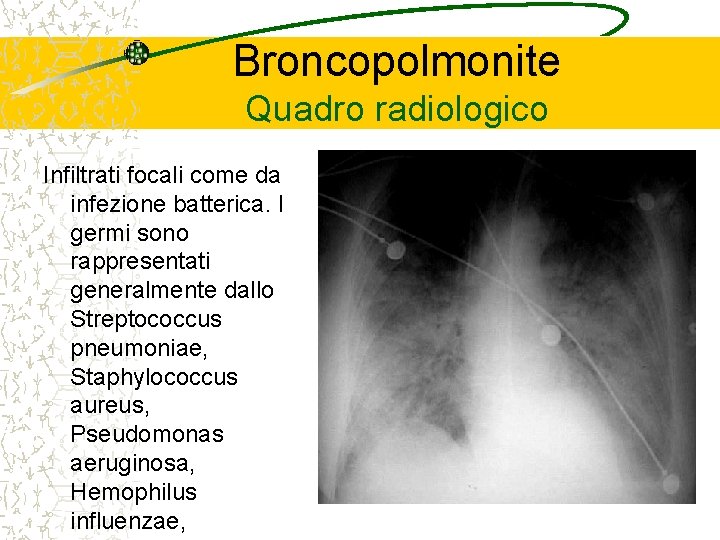Broncopolmonite Quadro radiologico Infiltrati focali come da infezione batterica. I germi sono rappresentati generalmente