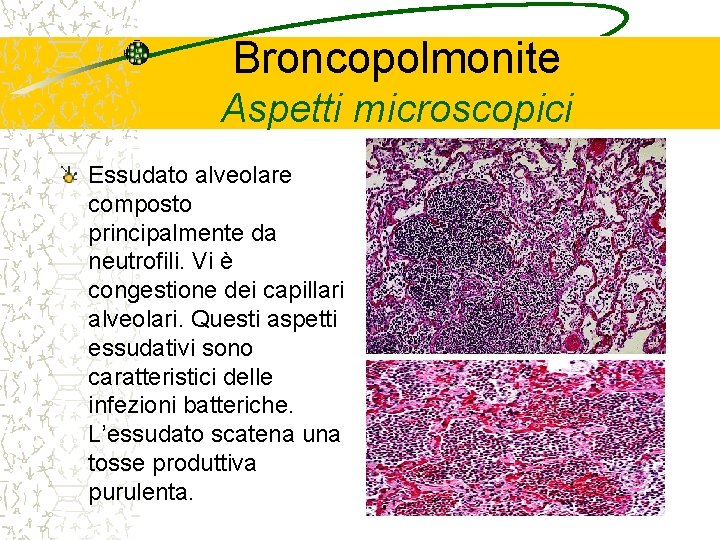 Broncopolmonite Aspetti microscopici Essudato alveolare composto principalmente da neutrofili. Vi è congestione dei capillari