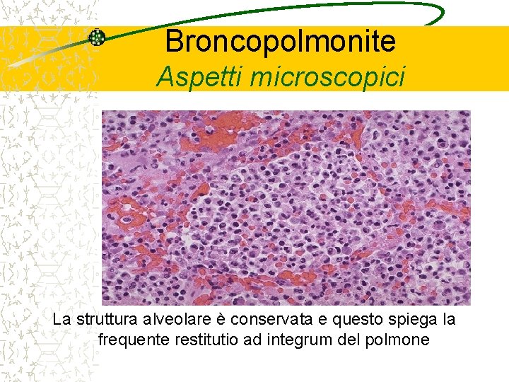 Broncopolmonite Aspetti microscopici La struttura alveolare è conservata e questo spiega la frequente restitutio