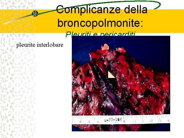 Complicanze della broncopolmonite: Pleuriti e pericarditi pleurite interlobare 