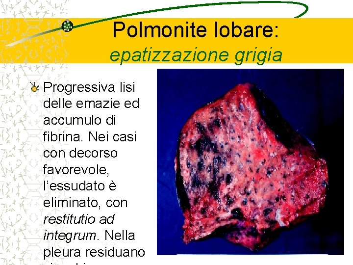 Polmonite lobare: epatizzazione grigia Progressiva lisi delle emazie ed accumulo di fibrina. Nei casi